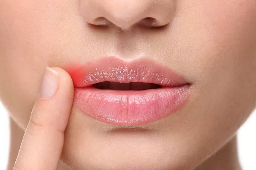 Заеды в уголках рта (хейлит): определение, разновидности болезни